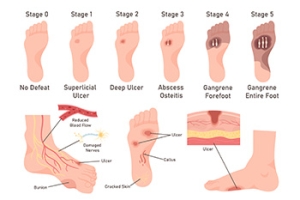 Safeguarding the Diabetic Foot from Ulcers
