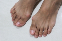 Treatment Options for Bunions