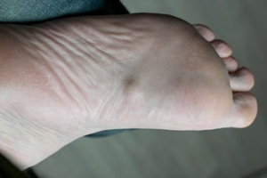 What You Need to Know About Plantar Fibromas