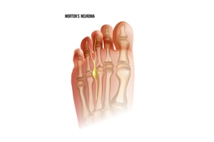 Morton's Neuroma and a Podiatrist's Help