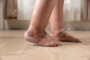 Swollen Feet Are a Warning Sign for Diabetic Patients