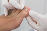 Treatment Approaches for Ingrown Toenails