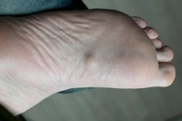 Understanding Plantar Fibromatosis and Ledderhose Disease