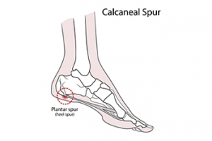How Are Heel Spurs Treated?