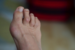 Surgery Options for Hammertoe Deformity