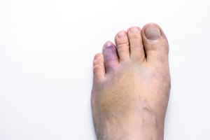 Broken Toes and the Role of a Podiatrist
