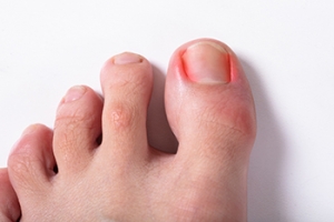 The Inconvenience of an Ingrown Toenail