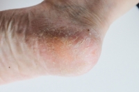 Mobility Threats and Risk Factors of Cracked Heels