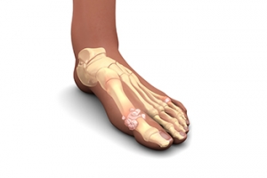 Effective Strategies for Relieving Gout Pain